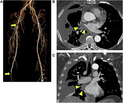 Case Report: Acute arterial occlusion of the right lower extremity due to left atrial invasion from pulmonary metastases of thyroid cancer